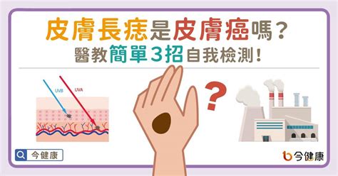 突然長痣|皮膚長痣是皮膚癌嗎？常見症狀，簡單3招自我檢測｜元氣